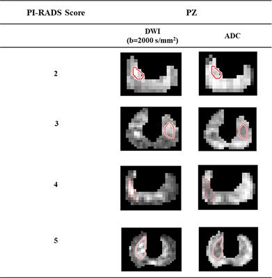 Machine learning-based analysis of a semi-automated PI-RADS v2.1 scoring for prostate cancer